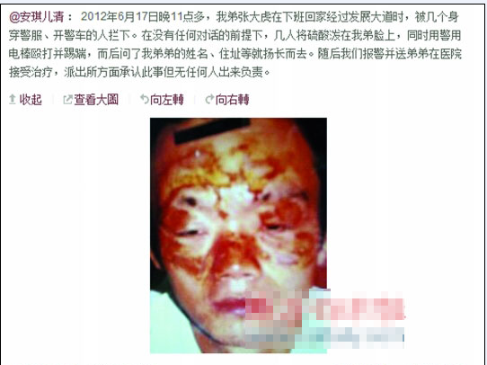 張大虎的姐姐將弟弟面部燒傷一事發(fā)上微博，引發(fā)網(wǎng)友廣泛關(guān)注。